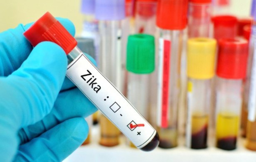 Três exames de detecção do vírus Zika são feitos