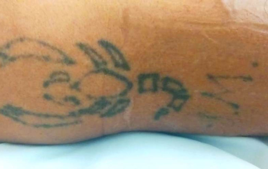Tatuagem que pode ajudar na identificação do paciente 