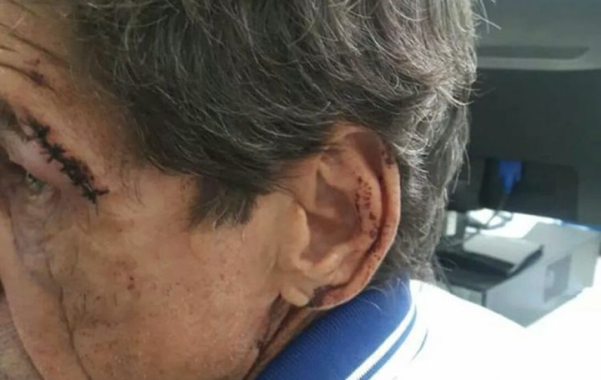 Idoso com ponto na sobrancelha pelo ferimento causado por barra de ferro