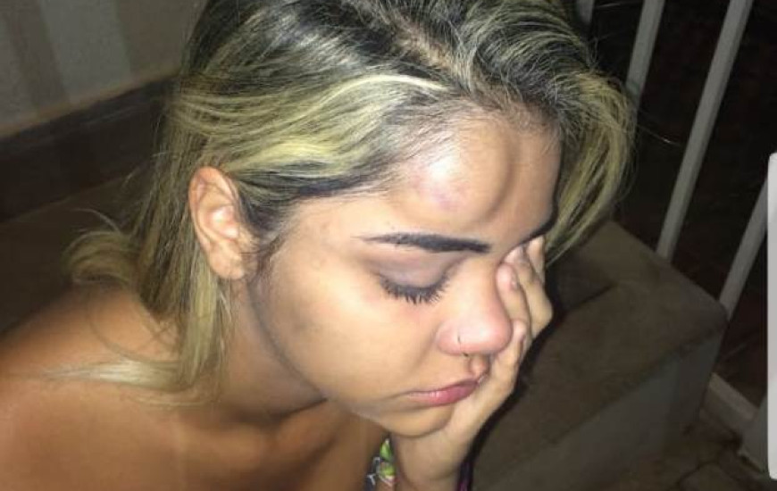 Angela postou fotos dos hematomas, com seu relato nas redes sociais
