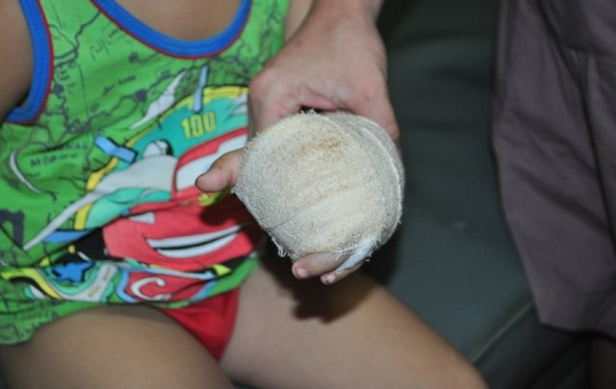 O menino teve dois dedos decepados no escorregador