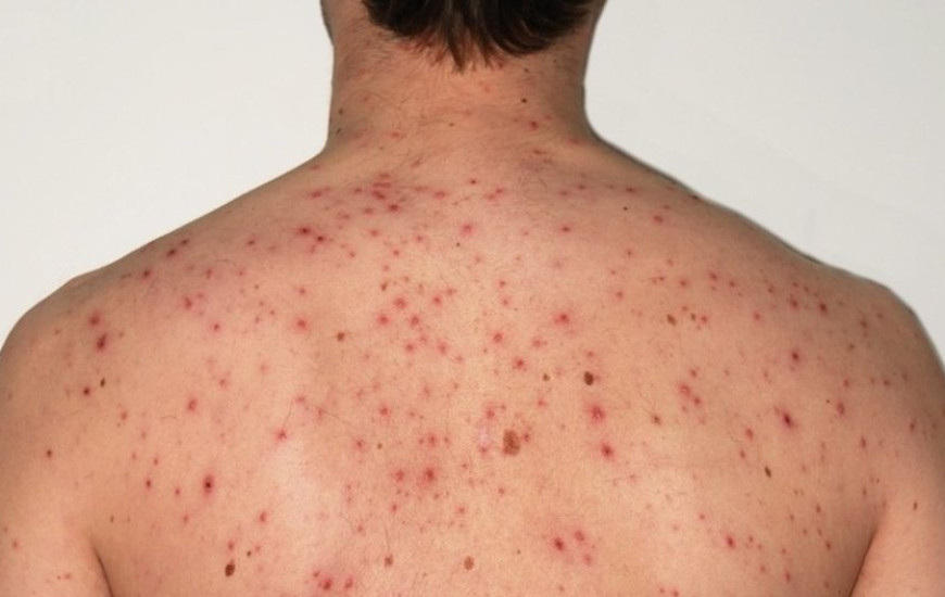 Tocantins investiga primeiros casos possíveis de Sarampo