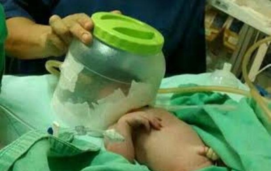 Recém-nascido com aparelho improvisado